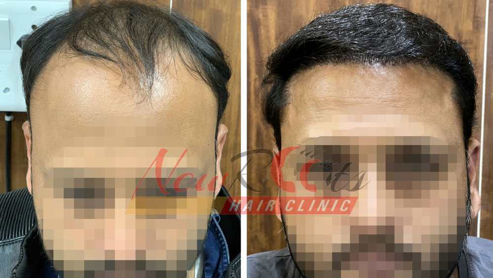 Results | Hair Transplant in India